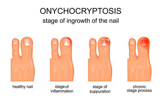 560 X 370 Ingrown Toenails Onychocryptosis - PODIATRY- LINK PAGE