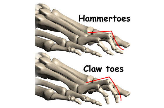 560 X 370 LESSER TOE DEFORMITIES-MALLET TOES, HAMMERTOES, CLAW TOES 2 - PODIATRY- LINK PAGE