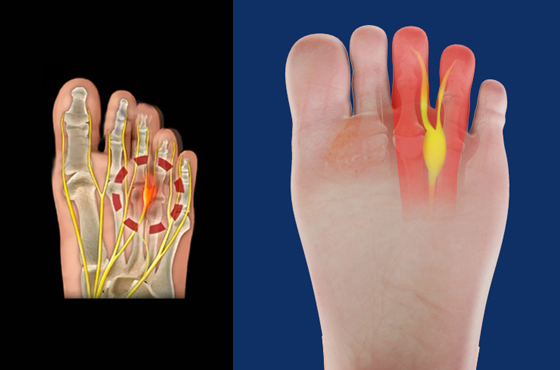 560 X 370 Neuroma or Morton’s neuroma - PODIATRY- LINK PAGE