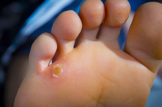 560 X 370 TCorns and Calluses - PODIATRY- LINK PAGE