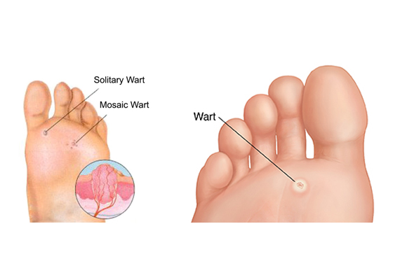 560 X 370 Warts - PODIATRY- LINK PAGE